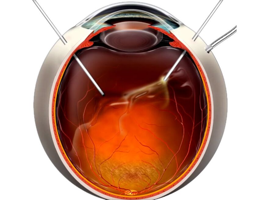 Vitrectomie - een procedure die aan mensen wordt getoond wanneer retinale scrubs